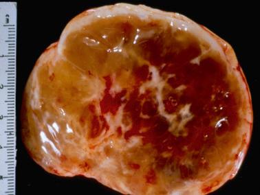Fig. 16.35, Fibroma. This tumor was soft and had a somewhat watery-appearing sectioned surface due to conspicuous edema.