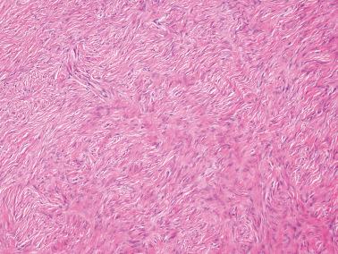 Fig. 16.38, Fibroma. The typical collagenous appearance of a fibroma is seen.