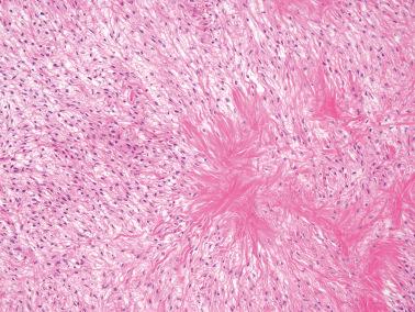 Fig. 16.39, Fibroma. This neoplasm shows both hyaline plaques and edema, imparting an appearance that occasionally may be misdiagnosed as a thecoma.