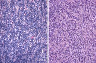 Fig. 16.4, Adult granulosa cell tumor. Left: A prominent trabecular growth of neoplastic granulosa cells is seen. Right: Delicate cords are set upon a background of a slightly cellular fibromatous stroma.