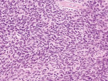 Fig. 16.42, Cellular fibroma. A high-power view of the prior case shows spindled to fusiform cells.