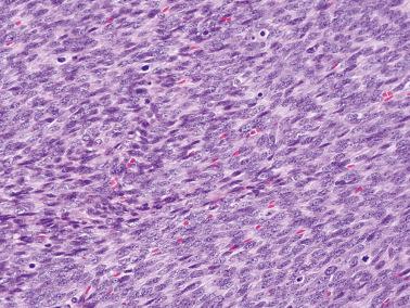 Fig. 16.46, Fibrosarcoma. A high-power view shows mild to moderate cytologic atypia and several mitotic figures.