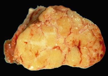 Fig. 16.47, Thecoma. The typical sectioned surface of a thecoma showing a lobulated yellow appearance.