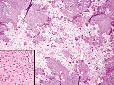 Fig. 16.50, Calcified thecoma. The typical thecoma cells are depicted in the inset.