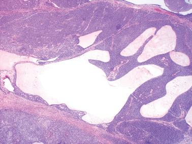 Fig. 16.5, Adult granulosa cell tumor. Macrofollicles, an uncommon feature of this neoplasm, are present.