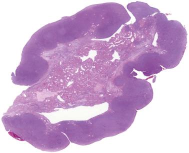 Fig. 16.51, Luteinized thecoma of the type associated with sclerosing peritonitis. A low-power view shows a thickened cortex with somewhat accentuated cerebriform pattern, a feature commonly seen in such lesions.