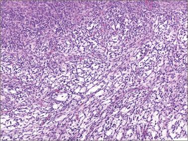 Fig. 16.52, Luteinized thecoma of the type associated with sclerosing peritonitis. A cellular neoplasm exhibits focal microcysts.