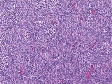 Fig. 16.53, Luteinized thecoma of the type associated with sclerosing peritonitis. This illustration shows packets of luteinized cells on a cellular fibromatous background.