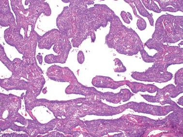 Fig. 16.7, Adult granulosa cell tumor. This neoplasm has a striking pseudopapillary architecture.