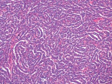 Fig. 16.8, Adult granulosa cell tumor. This neoplasm exhibits a striking gyriform pattern (most prominent at the left).