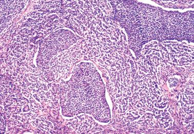 Fig. 16.9, Adult granulosa cell tumor. Insular pattern separated by prominent growth of neoplastic cells in cords.
