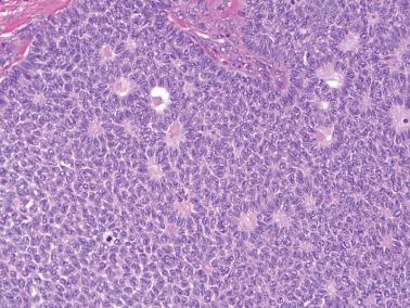 Fig. 16.10, Adult granulosa cell tumor. This illustration exhibits two characteristic features, Call–Exner bodies and pale nuclei, many with nuclear grooves.