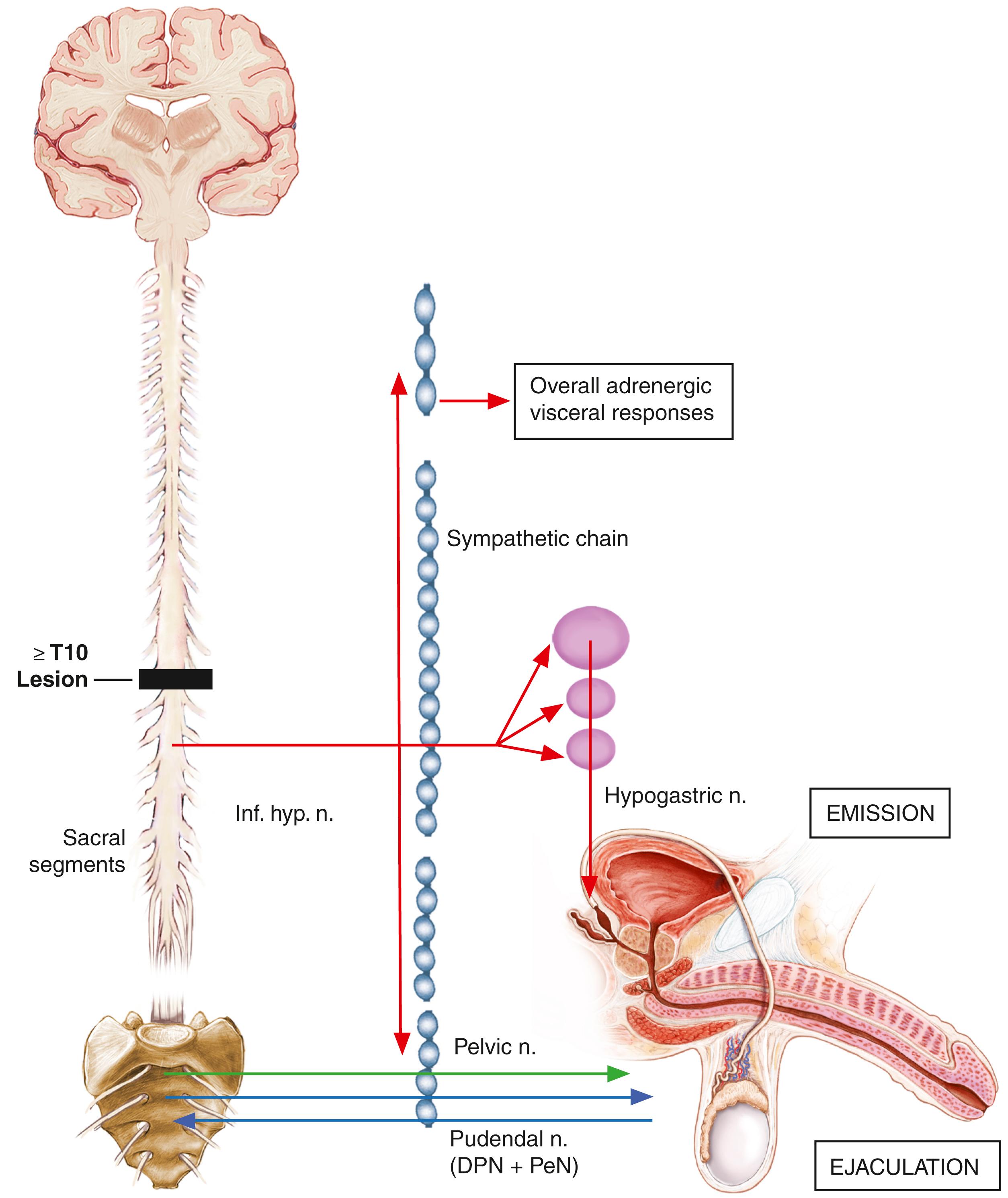 Fig. 46.5, Sexual Function Following Higher Spinal Lesions (≥10) in Males.