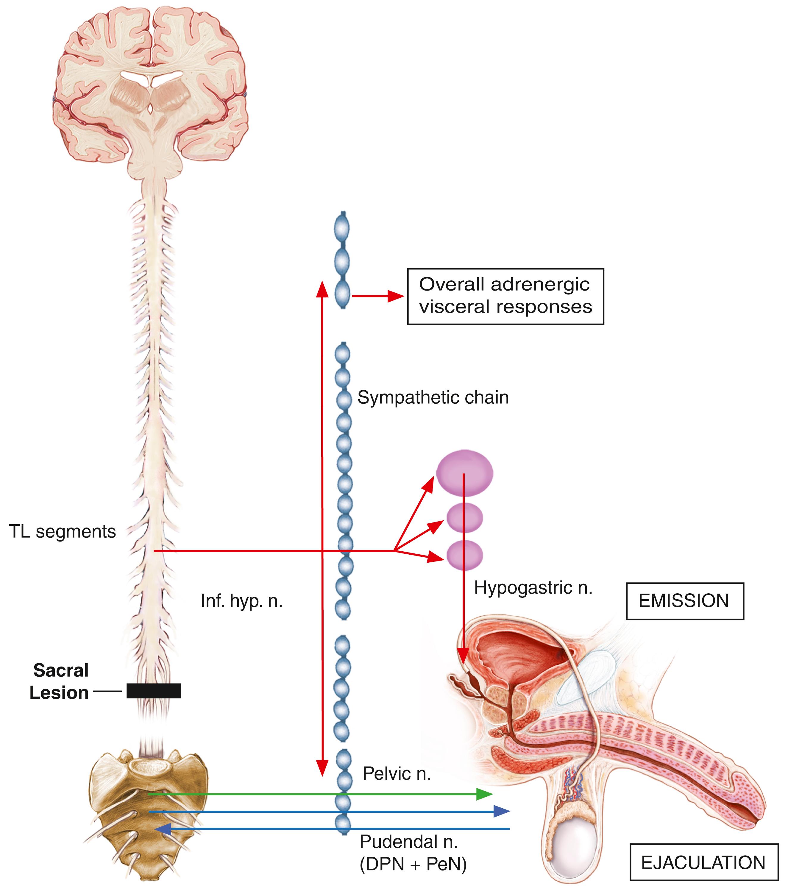 Fig. 46.6, Sexual Function Following Lower (Sacral) Lesions in Males.