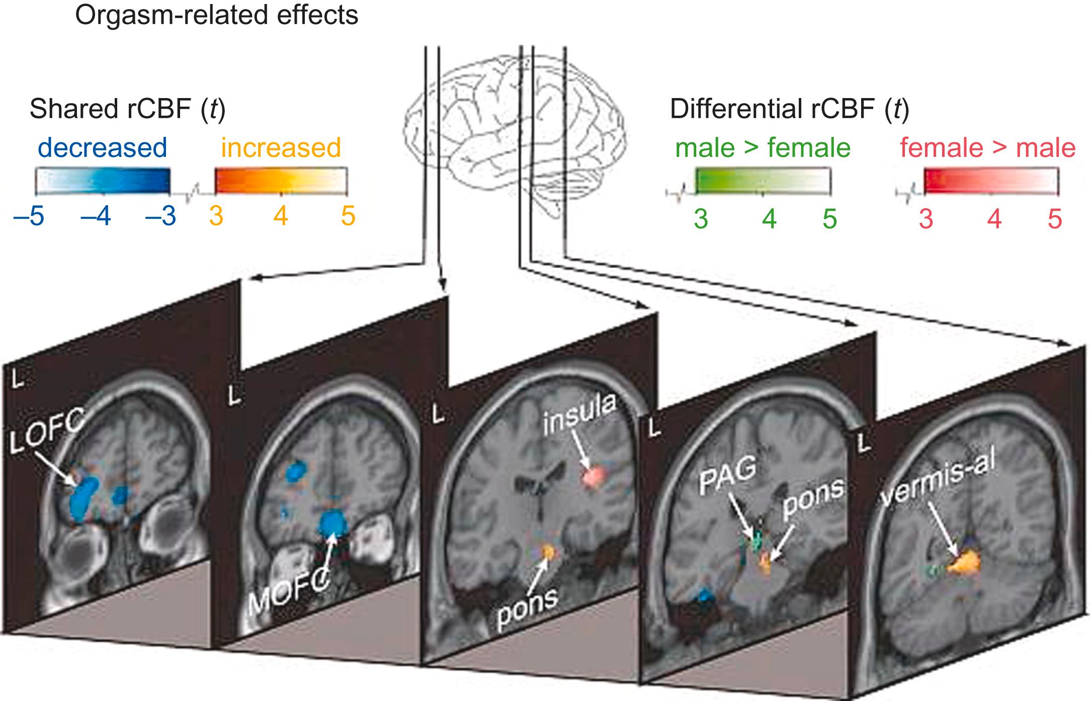 Figure 30-2, Functional neuroimaging during male and female orgasm. Orgasm-related effects were evaluated by comparing scans of orgasm with scans of sexual tactile genital stimulation. Activated (orange) and inactivated (blue) areas are the same in men and women. However, certain parts of the brain are more active only in men (green) or in women (red) . LOFC, Lateral orbitofrontal cortex; MOFC, medial orbitofrontal cortex; PAG, periaqueductal gray; rCBF, regional cerebral blood flow.