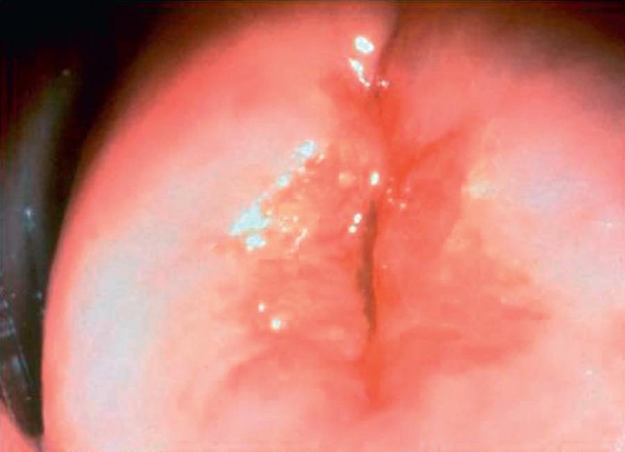 Fig. 146.3, Cervical ectopy.