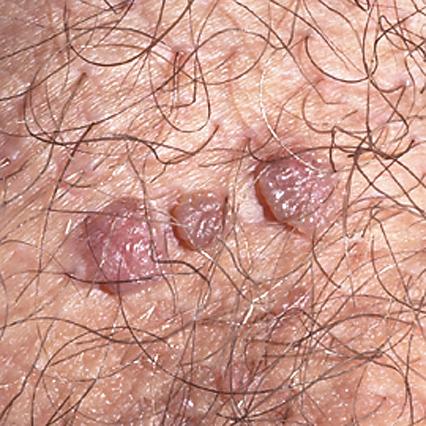 Warts (papules)