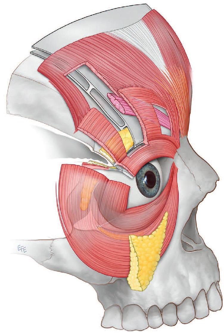 Fig. 17.2, Muscles affecting eyelids and brows. Also shown are ROOF, SOOF, malar fat pad, preaponeurotic fat.