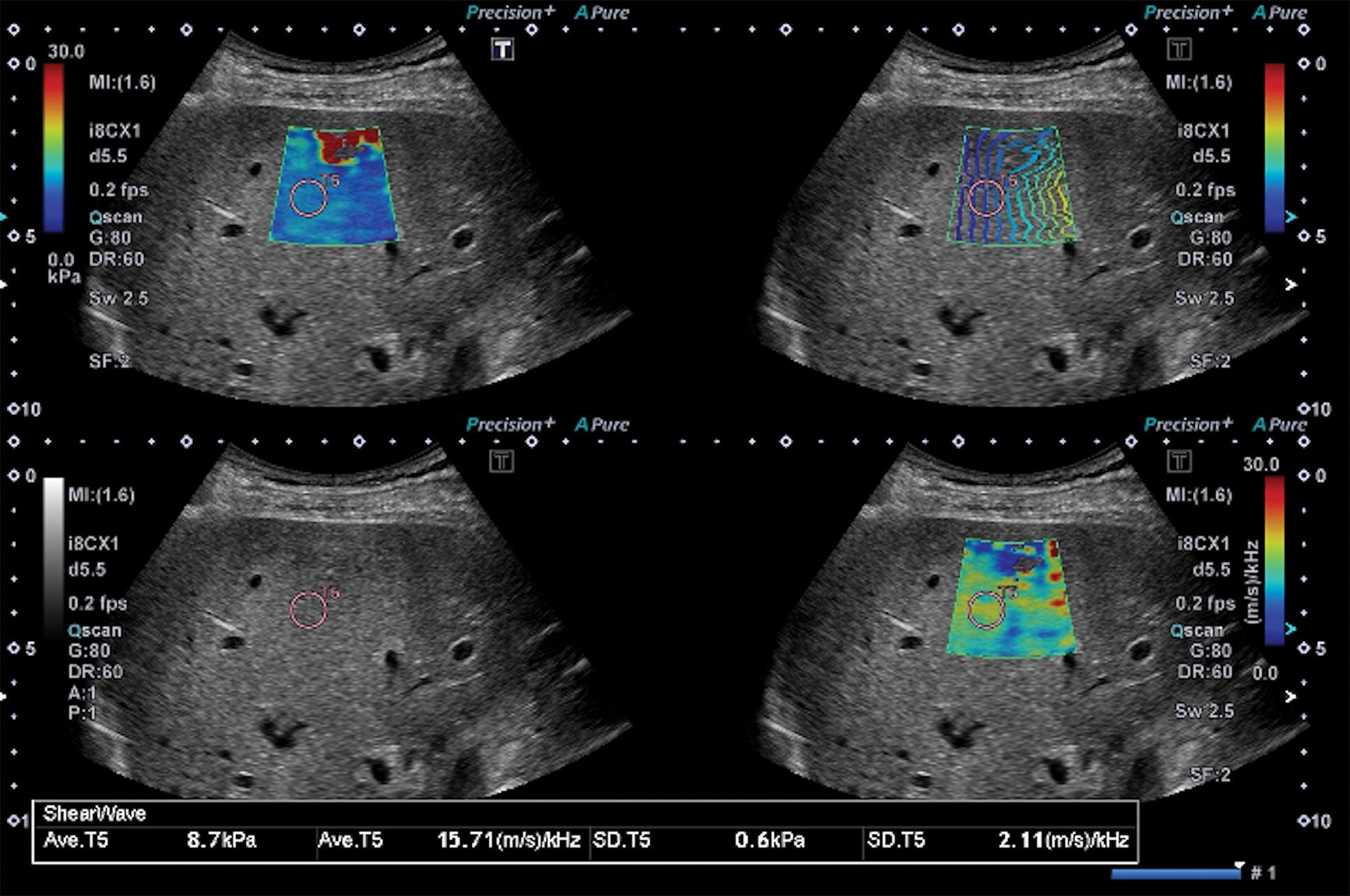 Fig. 12.3, Quad view for shear wave elastography/shear wave dispersion quantification. Upper left: elasticity map; upper right: propagation map; lower left: gray scale; lower right: dispersion map.