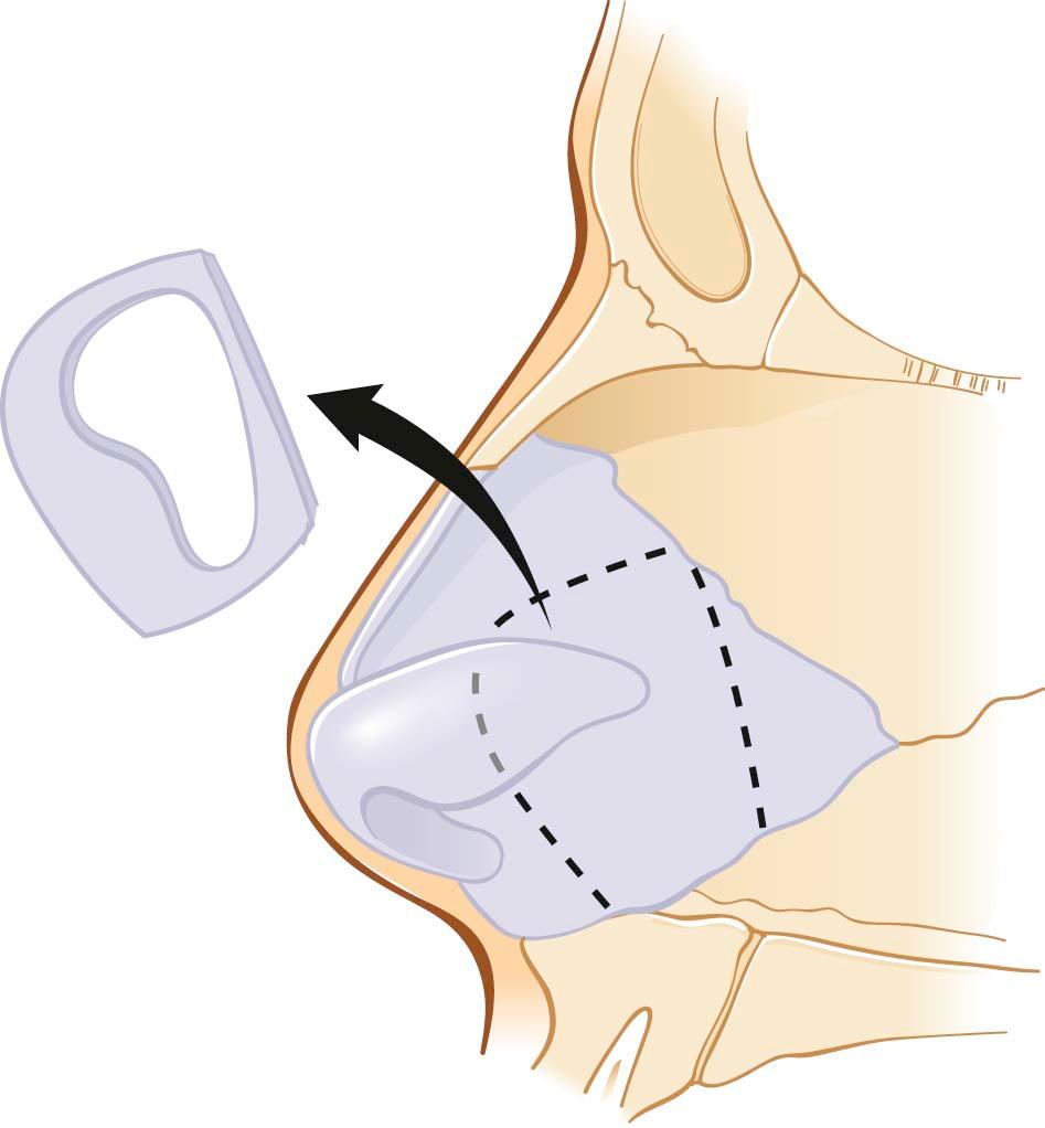 Figure 28-1, A caudal septal extension graft harvested from septal cartilage. The wedge shape allows for counter rotation and consequent lengthening of the nasal tip.