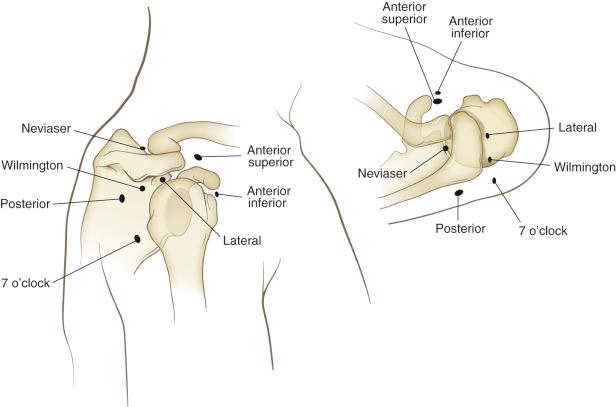 Fig. 39.2, A right shoulder demonstrating portal positions for the more standard posterior, anterior superior, anterior inferior, and lateral portals. Other common accessory portals shown include the Neviaser portal, the portal of Wilmington, and the 7 o'clock portal.