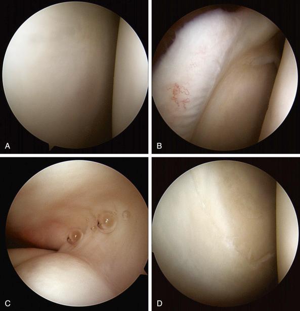 Fig. 39.3, A diagnostic shoulder scope.