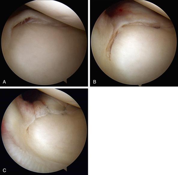 Fig. 39.4, A superior labral anterior to posterior (SLAP) tear.