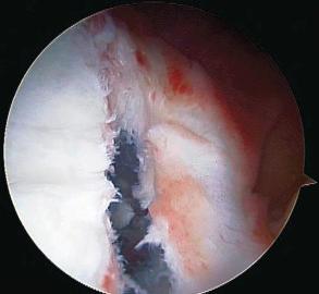 Fig. 39.5, A Bankart lesion.