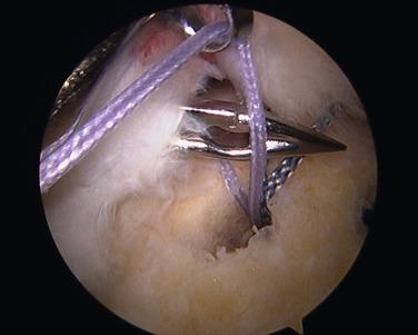 FIGURE 1.22, Tissue penetrator through cuff preparing to grasp suture from anchor.