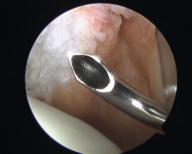 FIGURE 1.28, In vivo photo of shuttle suture passer tip.