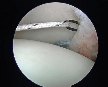 FIGURE 1.31, Nylon loop shuttles braided suture through the labrum.