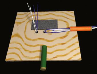 FIGURE 1.70, Pull the middle anchor suture strands out through the anterior cannula.