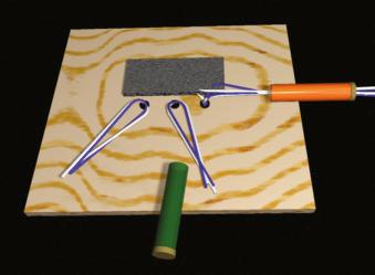 FIGURE 1.76, Place this suture through the felt, and withdraw it through the anterior cannula.