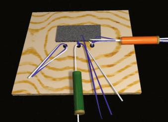 FIGURE 1.80, Retrieve one middle anchor white suture from the anterolateral stab wound, and withdraw it through the lateral cannula.