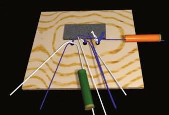 FIGURE 1.89, Withdraw the posterior anchor white suture strand from the posterolateral stab wound, and pull it out through the lateral cannula.