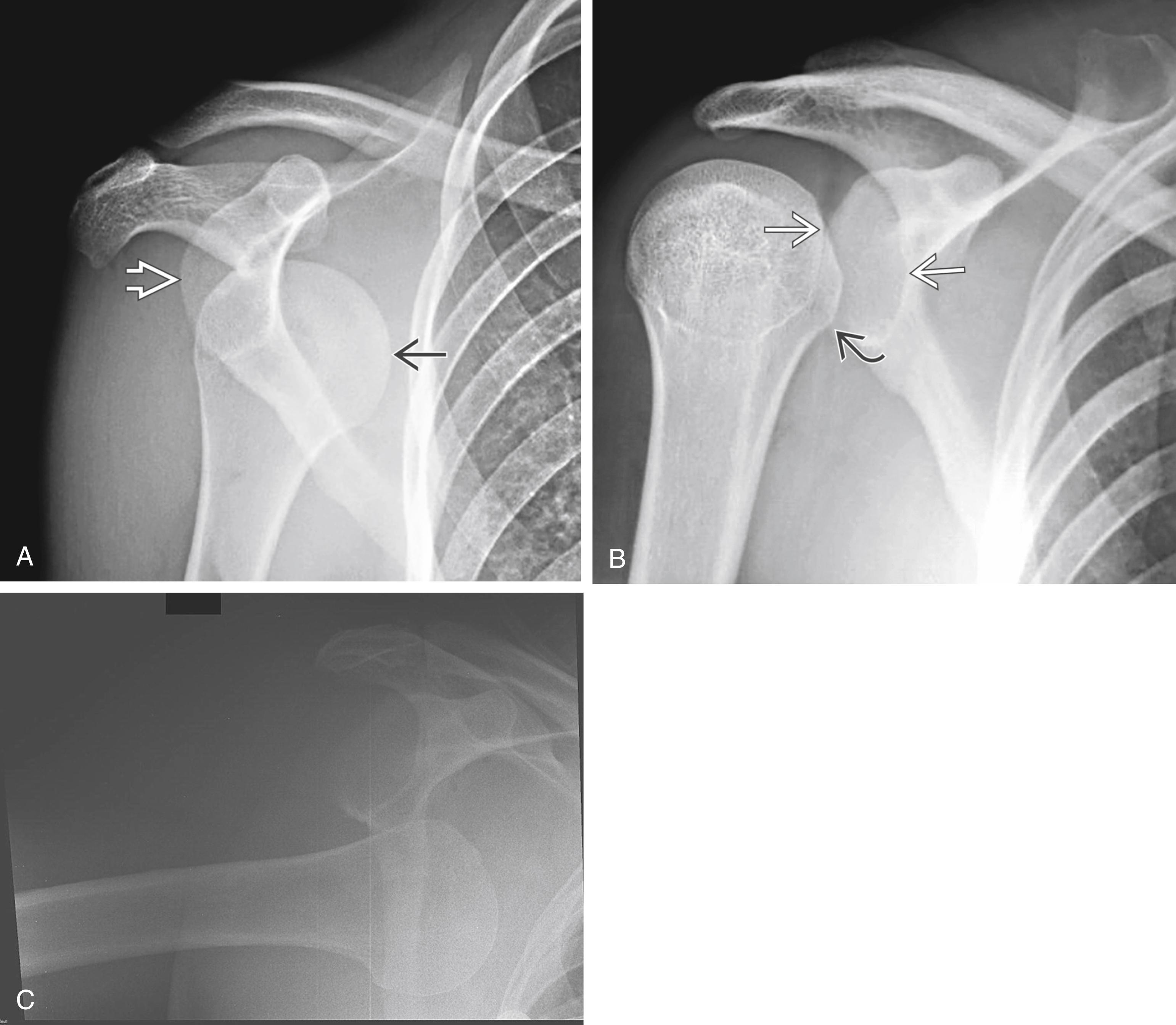 Fig. 128.2, (A) Anterior glenohumeral dislocation. Anteroposterior (AP) radiograph in a patient with shoulder pain after trauma shows inferior and medial displacement of the humeral head (black arrow) relative to the glenoid fossa (white arrow) . The humeral head in anterior dislocation is usually pulled medially by muscles and is displaced inferiorly under the coracoid process. (B) Posterior glenohumeral dislocation. AP radiograph shows a patient with shoulder pain after a motorcycle accident. Note the wide glenohumeral joint (white arrows), the so-called rim sign, and loss of the normal half-moon overlap. The humerus is also internally rotated, causing the light bulb sign, where the lesser tuberosity (black arrow) projects medially. (C) Inferior glenohumeral dislocation (luxatio erecta humeri). AP radiograph of right shoulder showing inferior dislocation of glenohumeral joint.