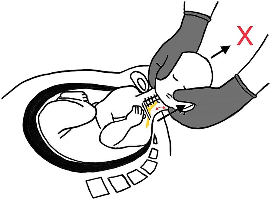 Fig. 9.1, Avoid traction on fetal neck during delivery as this can result in brachial plexus injury.