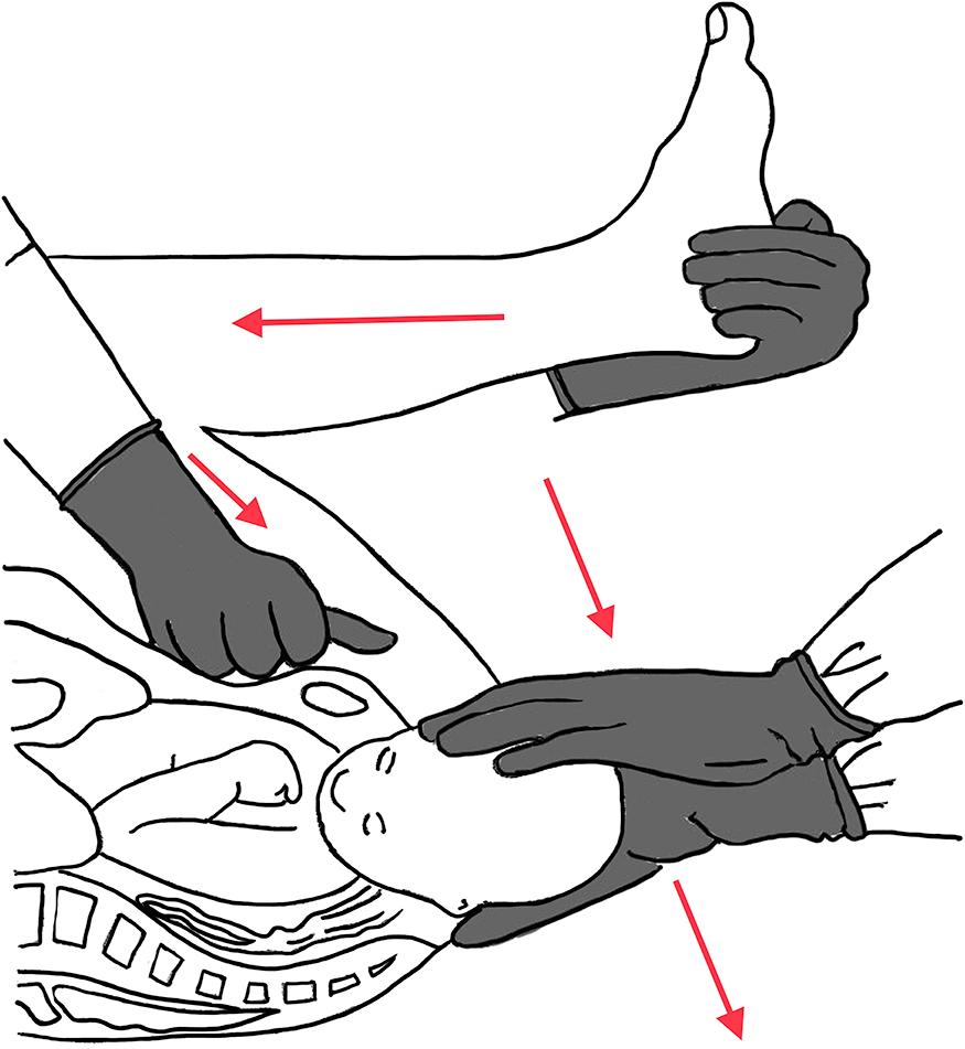 Fig. 9.2, McRoberts' maneuver and suprapubic pressure. Hips are flexed to flatten the sacral promontory. Suprapubic pressure decreases the bisacromial diameter. Together, these improve pushing efficiency.