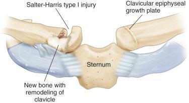 Fig. 133.11, Salter-Harris I fracture of the medial clavicle with anterior displacement.