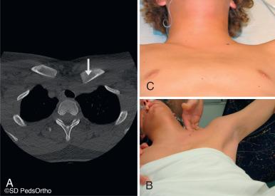 Fig. 133.13, A 14-year-old male who sustained a posteriorly displaced medial clavicle fracture. (A) A computed tomography scan confirms posterior displacement (arrow) . (B) In thin patients, the clavicle can sometimes be reduced using manual manipulation with traction on the arm. (C) Closed reduction was successful in this patient. He was then placed into a figure-of-eight brace.