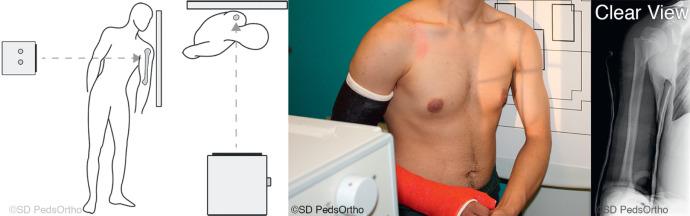 Fig. 133.16, The “clear view” may be performed orthogonal to the anteroposterior view. It allows accurate visualization with decreased radiation compared to the transthoracic view.