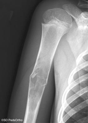 Fig. 133.17, Unicameral bone cyst (UBC) with a pathologic fracture through the humerus. The “fallen leaf” sign is pathognomonic for a UBC.