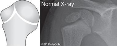 Fig. 133.3, Proximal humerus ossification centers.