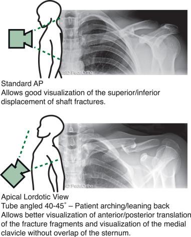 Fig. 133.4, Anteroposterior (AP) and apical lordotic views of the clavicle.