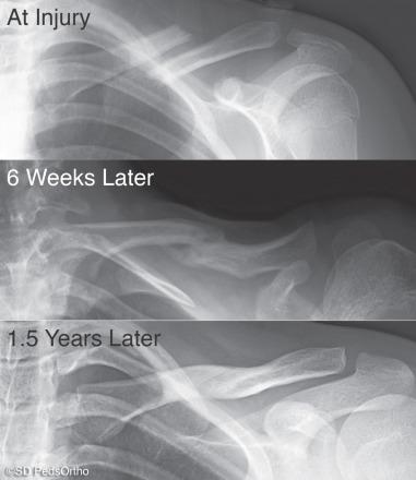 Fig. 133.5, Shortened midshaft clavicle fracture in a teenager demonstrating the remodeling potential of these fractures.