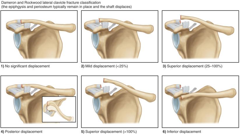 Fig. 133.8, Dameron and Rockwood classification of pediatric distal (lateral) clavicle fractures.