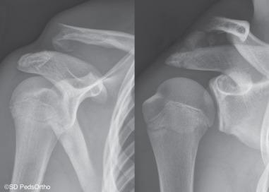 Fig. 133.9, Anteroposterior and Zanca views of the distal clavicle.