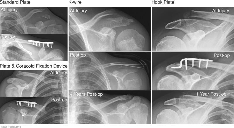 Fig. 133.10, Surgical options for lateral clavicle fractures.