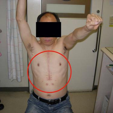 FIG. 28.1, The patient shows forward elevation of 100 degrees or less with global limitation of motion. The patient had recent major cardiac surgery (orange circle) , which makes frozen shoulder more likely to occur.