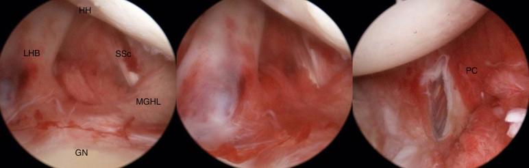 FIG. 28.2, Arthroscopic view of the glenohumeral joint. The left figure shows inflamed structure of anterior structures of the joint. Center figure show close up view of the rotator interval and biceps long head tendon. One can easily see severe inflammation of the capsule. Right figure is view of the posterior capsule also having severe redness and inflammation. GN, Glenoid; HH, humeral head; LHB, long head of biceps tendon; MGHL, middle glenohumeral ligament; PC, posterior capsule; SSc, subscapularis tendon.